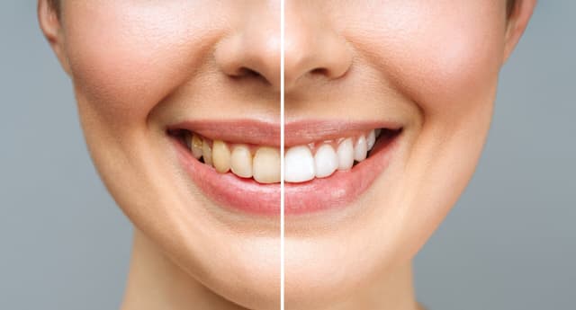 Imagen /images/blanqueamiento-dental.jpg